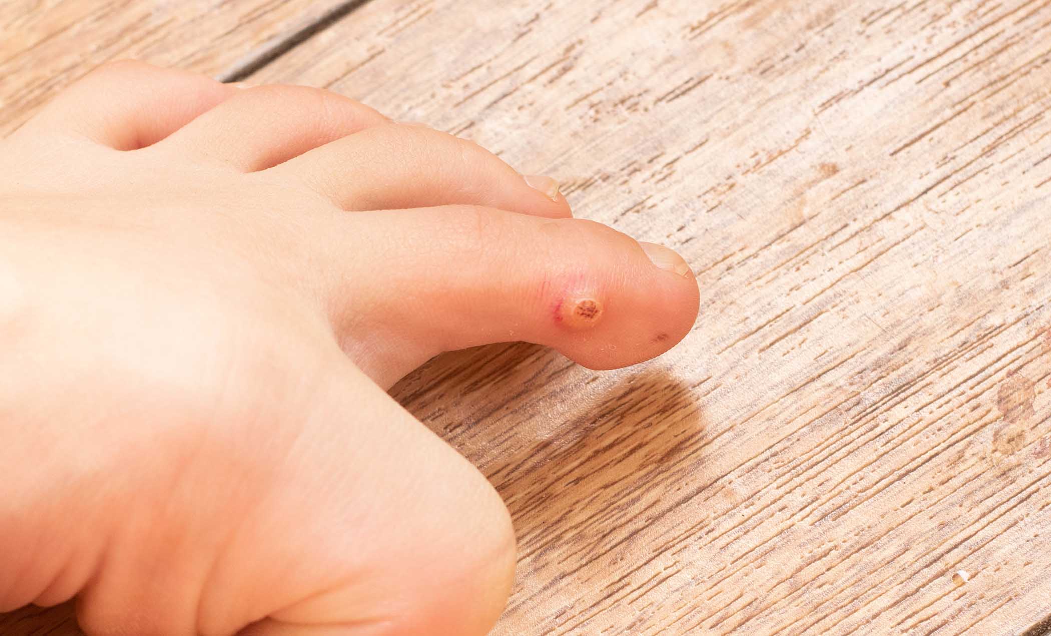 Wart Home Remedies Wart Home Remedies