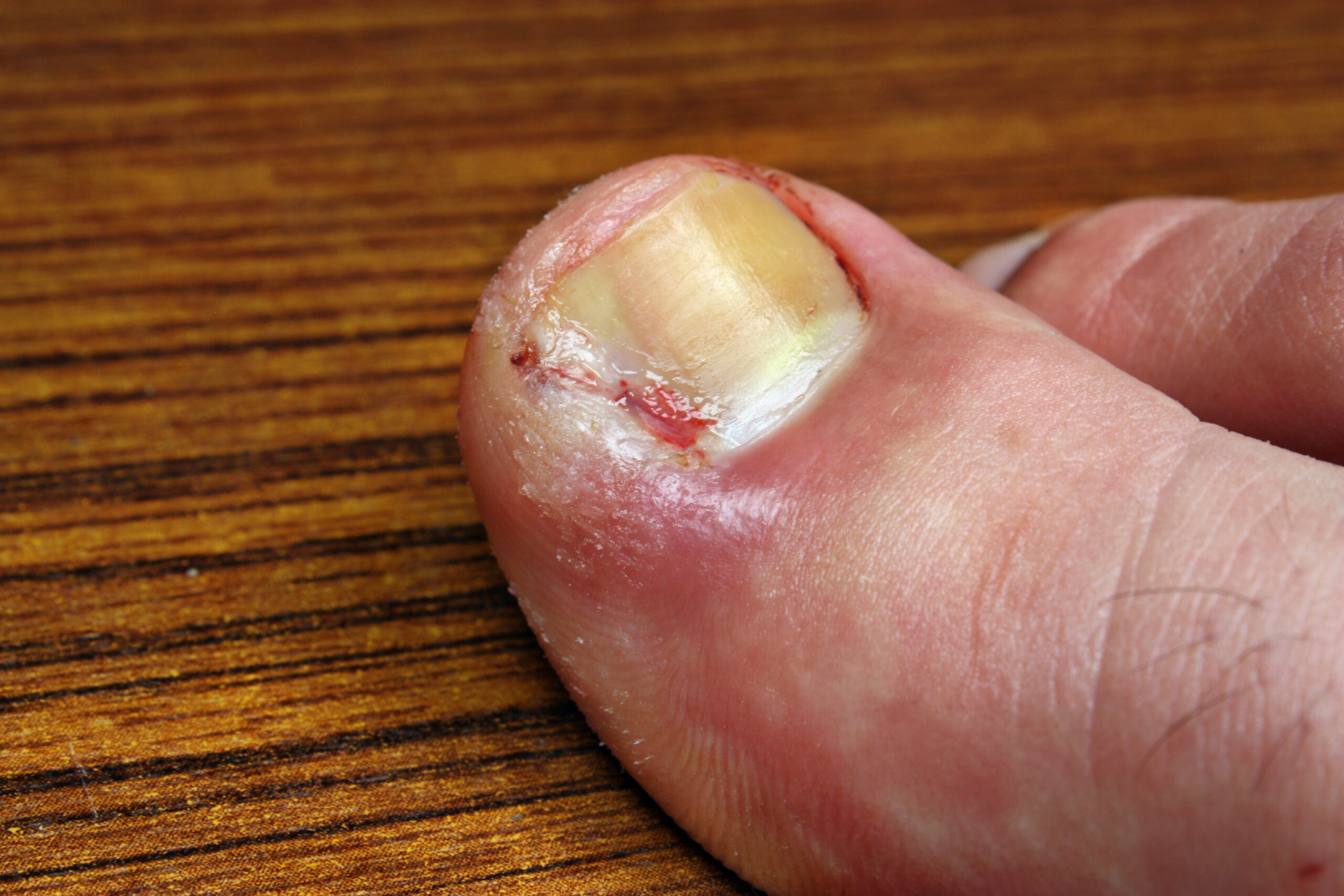 Ingrown toenail disease blood wound infection bacteria  finger  skin scab pus  toe liquid whitlow felon treatment swelling on a brown table background