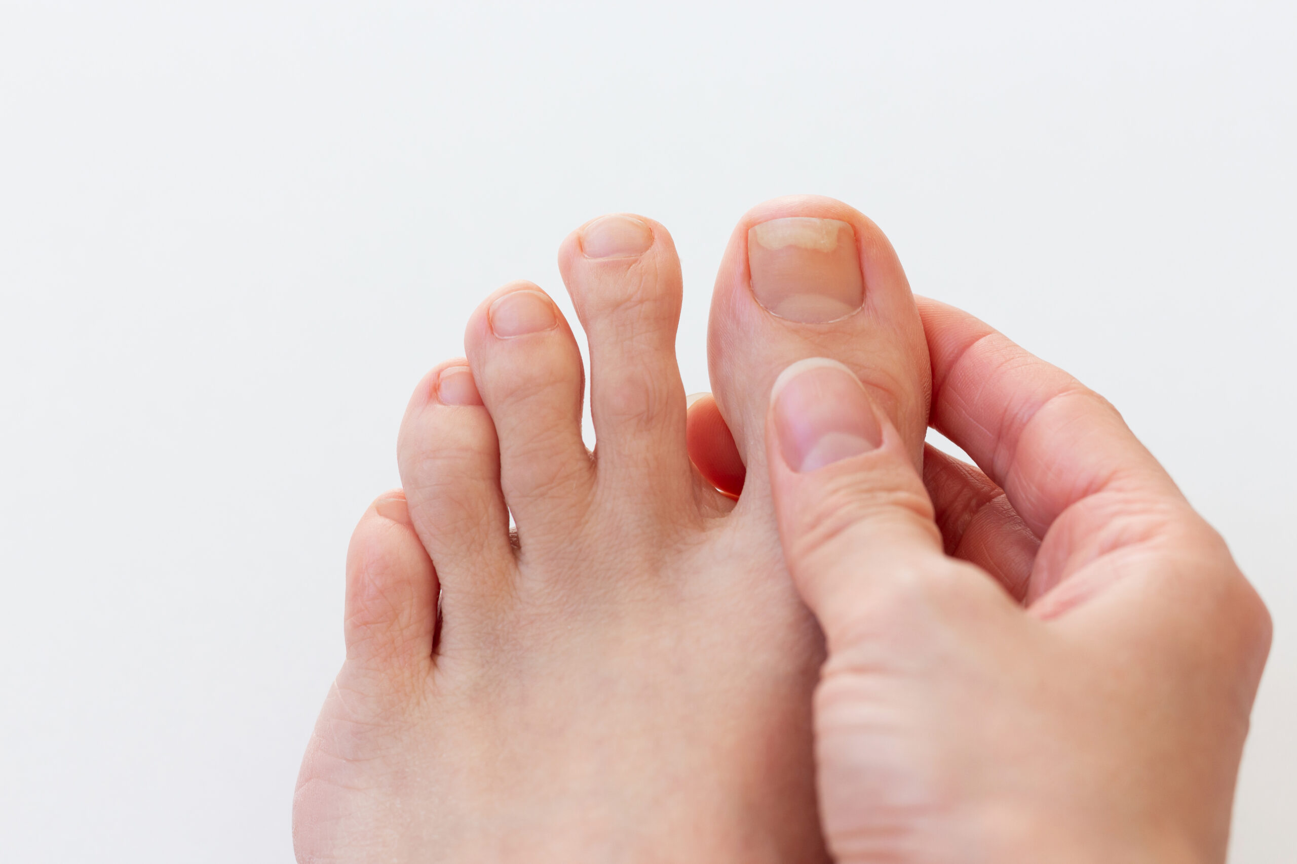 Close up of hand holding female foot with damaged toenail affected by fungus infection or onycholysis disease over white background. Close up of hand holding female foot with damaged toenail affected by fungus infection or onycholysis disease over white background.